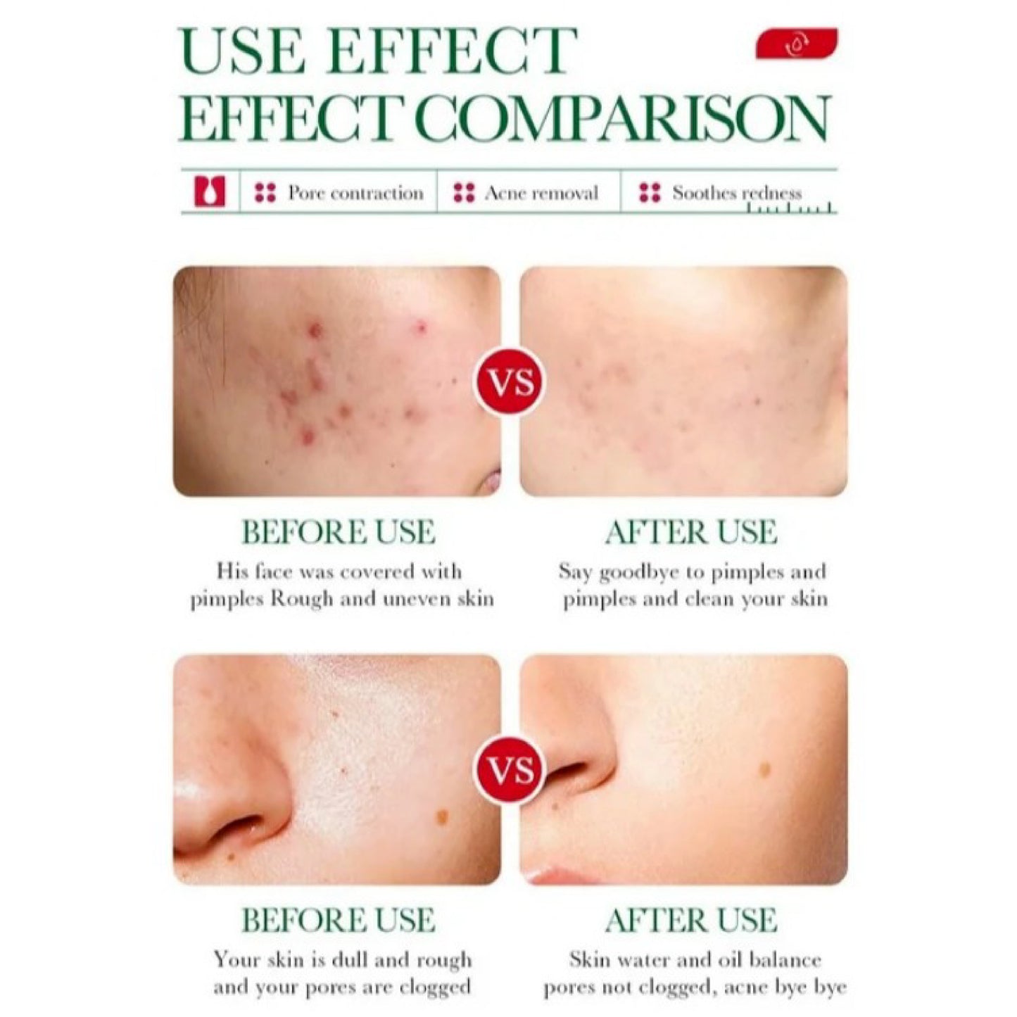 Bioaqua Salicylic Acid Acne Essence